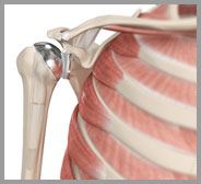 Shoulder Joint Replacement Clavicle Fracture